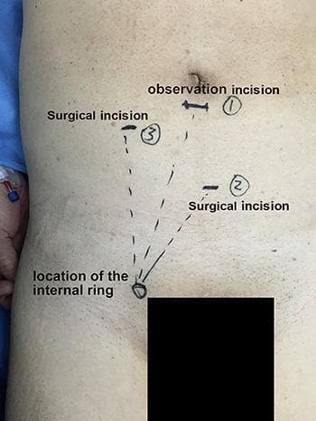 Hugging Face pmc clinical VQA raw