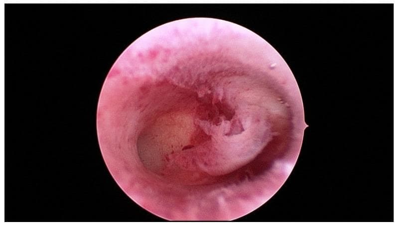 A diagnostic hysteroscopic photograph showing the interior of a human uterine cavity (cavum uteri). The image illustrates the endometrial lining, which appears pink and red with varying vascularity and thickness. In the center of the cavity, there is a prominent, raised area of endometrium, creating an irregular surface elevation against the surrounding uterine wall. The overall appearance of the cavity is described as inconspicuous, meaning it lacks obvious gross pathology like large submucosal fibroids, polyps, or significant synechiae. This visualization is characteristic of a standard diagnostic hysteroscopy used in gynecology to evaluate the uterine environment for infertility, recurrent miscarriage, or abnormal bleeding. The view captures the distal end of the uterine cavity, emphasizing the morphology and texture of the endometrial tissue under endoscopic magnification.