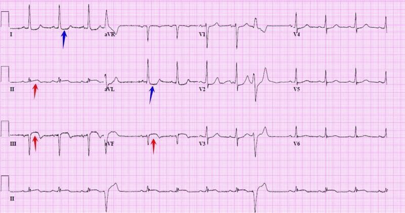A standard 12-lead diagnostic electrocardiogram (ECG) demonstrating an acute ST-elevation myocardial infarction (STEMI) in the inferior wall distribution. The tracing shows a regular sinus rhythm with narrow QRS complexes. Key diagnostic features include significant ST-segment elevation in the inferior leads (II, III, and aVF), highlighted by red arrows, which is highly suggestive of an acute right coronary artery (RCA) or left circumflex (LCx) artery occlusion. Reciprocal ST-segment depression and T-wave inversion are clearly visible in the high lateral leads (I and aVL), marked by blue arrows. The precordial leads (V1-V6) show relatively stable baselines without prominent acute ST-T changes. This image serves as a classic educational example of inferior myocardial injury with characteristic reciprocal changes, appropriate for teaching ECG interpretation, cardiology diagnostics, and emergency cardiovascular care protocols.