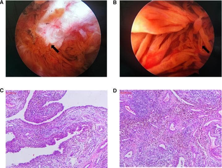 A multi-panel figure containing intraoperative arthroscopic photographs and histopathology slides related to Tenosynovial Giant Cell Tumor, localized type (formerly Pigmented Villonodular Synovitis - PVNS). Panel A shows an arthroscopic view of bone erosion on the medial femoral condyle, indicated by an arrow, characterized by irregular, white fibrillated tissue and exposed bone. Panel B demonstrates synovial proliferation with characteristic yellowish-orange, finger-like villous projections and nodules typical of PVNS. Panels C and D are light microscopy images of excised synovial tissue stained with Hematoxylin and Eosin (H&E) and CD68 immunohistochemistry. The histology reveals synovial hyperplasia with a dense infiltrate of mononuclear cells, foamy macrophages, multinucleated giant cells, and prominent brownish hemosiderin deposits. These panels illustrate the diagnostic features used in orthopedic surgery and pathology to identify proliferative synovial disorders in pediatric patients.