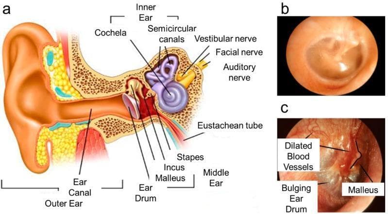 This medical educational graphic comprises an anatomical diagram and clinical otoscopic photographs illustrating the human ear in healthy and pathological states. Panel (a) is a cross-sectional anatomical diagram of the human ear, labeling key structures including the outer ear (pinna, ear canal), middle ear (eardrum/tympanic membrane, malleus, incus, stapes), and inner ear (cochlea, semicircular canals, vestibular and auditory nerves, Eustachian tube). Panel (b) shows a healthy tympanic membrane via white light otoscopy, characterized by a translucent, pinkish-gray appearance, a normal light reflex, and a concave shape. Panel (c) provides a comparative otoscopic view of acute otitis media. Pathological markers labeled include a bulging eardrum due to middle ear pressure, intense erythema (redness), and dilated blood vessels (vascular injection) across the membrane surface. The malleus remains visible but appears distorted by the inflammatory swelling. The image serves to teach the visual diagnostic criteria for middle ear infections compared to normal anatomy.