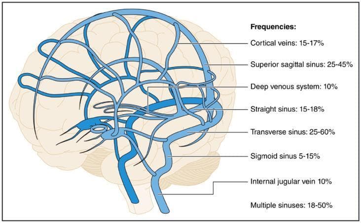 This medical anatomical diagram illustrates the cerebral venous system superimposed on a lateral view of the human brain. The illustration highlights the complex network of superficial and deep drainage pathways. Key anatomical structures labeled include the superior sagittal sinus along the dorsal midline, the cortical veins, the deep venous system (including the internal cerebral veins), the straight sinus, the transverse and sigmoid sinuses, and the internal jugular vein. The diagram serves as an educational infographic for Cerebral Venous Thrombosis (CVT), providing statistical frequencies of clot occurrence at specific anatomical sites: Transverse sinus (25-60%), Superior sagittal sinus (25-45%), Multiple sinuses (18-50%), Straight sinus (15-18%), Cortical veins (15-17%), Deep venous system (10%), Internal jugular vein (10%), and Sigmoid sinus (5-15%). The visual emphasizes the confluence of sinuses and the transition from dural venous sinuses to the extracranial venous system, providing clinical relevance for neurology and radiology residents studying stroke and vascular pathology.