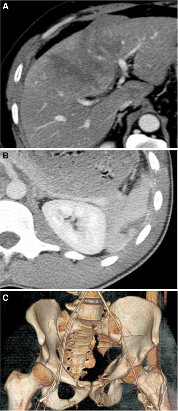 This composite diagnostic image illustrates traumatic solid organ and skeletal injuries using computed tomography (CT). Panel A shows an axial CT scan of the liver demonstrating an AAST Grade II liver injury, characterized by a low-density subcapsular hematoma and a focal intraparenchymal hematoma. Panel B displays a contrast-enhanced axial CT scan of the abdomen featuring a Grade II splenic laceration, visible as a linear hypodensity within the splenic parenchyma. Panel C presents a 3D CT reconstruction of the pelvis showing complex multisite fractures following high-energy trauma. Notable findings include displaced fractures of the left superior and inferior pubic rami, a left acetabular fracture, a left sacral fracture with moderate displacement, and a left intertrochanteric femur fracture. Non-displaced fractures of the right pubic rami are also suggested. The series serves as an educational resource for identifying visceral and pelvic girdle trauma on cross-sectional and reconstructed imaging, emphasizing injury grading systems and anatomical displacement.