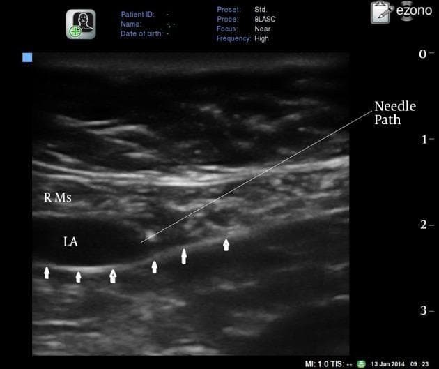 A transverse grayscale ultrasound image demonstrating a rectus sheath block procedure in the abdominal wall, located at or just above the umbilicus. The rectus abdominis muscle (RMs) is visualized as a relatively large, heterogeneous area in the superficial to mid-field. Below the muscle, a significant hypoechoic (dark) collection of local anesthetic (LA) is seen, illustrating hydrodissection between the muscle and the posterior rectus sheath. Small white arrows highlight the hyperechoic, linear posterior rectus sheath and fascia transversalis, which form the deep boundary of the injection site. An annotated white line indicates the 'Needle Path', demonstrating an in-plane approach from the lateral aspect toward the potential space between the muscle and the posterior sheath. This diagnostic image serves as an educational guide for regional anesthesia, highlighting essential sonographic landmarks and needle placement for effective blockade of the somatic sensory nerves (intercostal nerves T7-T11) within this anatomical plane.