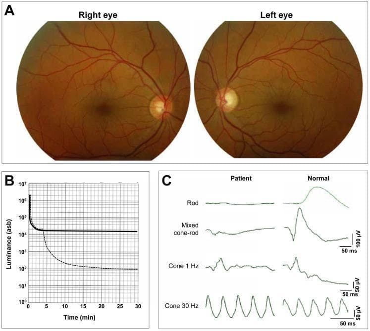 Educational panel of clinical ophthalmological investigations for congenital stationary night blindness (CSNB). Section A displays bilateral color fundus photographs showing a normal appearance of the posterior pole, macula, and optic discs with non-attenuated retinal vessels. Section B presents a dark-adaptation curve (luminance vs. time); the patient's curve (solid line) shows a normal initial cone adaptation but a total absence of the rod-adaptation phase, resulting in a threshold significantly higher than the control (hatched line). Section C shows full-field electroretinogram (ERG) recordings. Compared to the normal control, the patient demonstrates an absence of scotopic rod responses and a characteristic 'electronegative' mixed cone-rod response, where the a-wave is present but the b-wave is severely reduced or absent. Photopic cone responses (1 Hz and 30 Hz flicker) remain relatively normal. These findings are diagnostic of the Schubert-Bornschein type of CSNB, specifically illustrating the physiological deficit in signal transmission from photoreceptors to bipolar cells despite a clinically normal-appearing fundus.