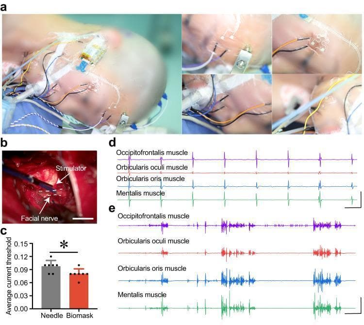 This multi-panel figure demonstrates intraoperative facial nerve monitoring during vestibular schwannoma surgery. Panel A shows clinical photographs of a patient's face in the surgical position, illustrating the concurrent placement of traditional needle electrodes and a novel, flexible 'Biomask' sensor array over key facial muscles, including the occipitofrontalis, orbicularis oculi, orbicularis oris, and mentalis. Panel B is a close-up intraoperative photograph showing an electrical stimulator probe applied to the exposed facial nerve (indicated by a dashed white line). Panel C provides a quantitative comparison of stimulation current thresholds between the two monitoring systems, indicating lower thresholds for the Biomask. Panels D and E display electromyography (EMG) waveforms recorded by the Biomask. Panel D shows rhythmic, stimulation-induced EMG signals, while Panel E illustrates erratic, high-frequency waveforms typical of mechanical traction or surgical manipulation of the nerve. The figure evaluates the clinical efficacy of flexible microneedle arrays in providing real-time neurophysiological feedback during neurosurgery to prevent iatrogenic nerve injury.