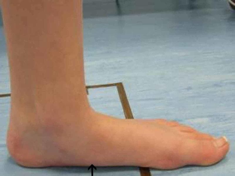 A clinical photograph depicting a medial view of a human left foot during a pre-operative gait analysis. The image highlights significant orthopedic pathology, specifically pes planus (flat foot). The medial longitudinal arch is visibly collapsed, with a flattened curvature and minimal clearance from the ground. A black arrow indicates the point of maximal descent of the medial arch. The ankle and heel alignment suggest hindfoot valgus and pronation of the midfoot, common findings in pes planovalgus deformity. This visual is used for clinical assessment of pediatric or adult flatfoot deformity to evaluate weight-bearing alignment and the redistribution of plantar pressure. It serves as an educational tool for identifying structural foot abnormalities and documenting baseline anatomical states prior to corrective orthopedic intervention.