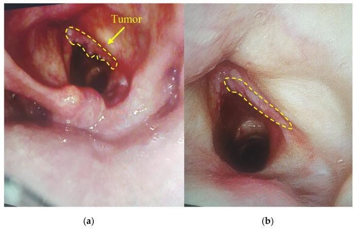 This comparison clinical photograph features two side-by-side endoscopic images of the laryngeal region, specifically focusing on the vocal cords before and after photodynamic therapy (PDT) for squamous cell carcinoma. Image (a) represents the pre-treatment state, showing an irregular, exophytic mass labeled as 'Tumor' on the right vocal cord. The lesion exhibits a rough, nodular surface with mottled pink and white coloration and signs of increased hypervascularity and tissue density. Image (b) shows the same anatomical site one week after PDT. In the post-treatment image, the previously highlighted region demonstrates significant tumor regression, characterized by a smoother surface texture, more uniform pink mucosal color, and a reduction in both tissue volume and vascular prominence. This comparative view illustrates the efficacy of PDT in inducing necrosis and flattening of malignant laryngeal neoplasms, highlighting its clinical utility in treating glottic squamous cell carcinoma.