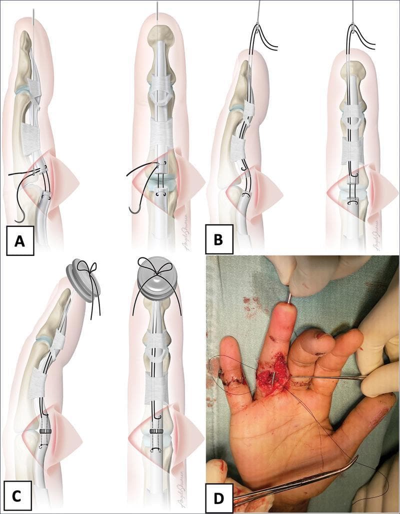 A multi-panel educational graphic demonstrating a modified pull-out suture technique for flexor digitorum profundus (FDP) tendon repair in the hand. Panels A, B, and C provide anatomical illustrations in lateral and anterior views, while panel D is a corresponding intraoperative clinical photograph. Panel A shows the introduction of a specialized 1.4 mm suture passer through the osteofibrous tunnel and digital pulp. Panel B illustrates the retrieval of 3-0 mononylon suture ends, previously secured to the proximal FDP stump via a modified Kessler tie, being guided distally toward the fingertip. Panel C depicts the final fixation of the pull-out sutures over a protective silicone button (shield) on the digital pulp, shifting traction forces away from the primary repair site. Panel D shows the clinical application, highlighting the mid-palmar incision, the suture passer exiting the distal tip of the third finger, and the use of surgical instruments to manage the suture threads. This technique is designed for hand surgery training, emphasizing tendon gliding preservation and soft tissue protection during early mobilization.