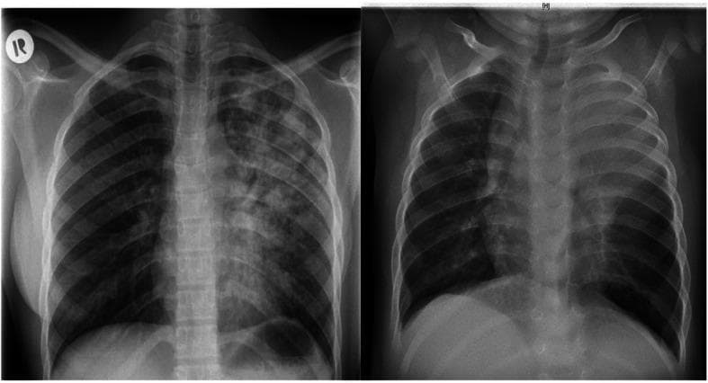This side-by-side comparison displays two posteroanterior (PA) chest X-rays illustrating the diverse radiographic presentations of pulmonary tuberculosis (TB) in adult versus pediatric patients. The adult image (left) demonstrates extensive, heterogeneous, patchy infiltrates and areas of consolidation predominantly involving the left lung field, typical of post-primary or reactivation TB. Visible radiolucencies suggest cavitation within the upper lobe. In contrast, the pediatric image (right) shows a different pattern characterized by diffuse, relatively homogeneous opacification throughout both lung fields. Notable features in the pediatric X-ray include significant widening of the superior mediastinum, which is highly suggestive of bilateral mediastinal lymphadenopathy, a hallmark of primary TB in children. Both cases exhibit reduced lung clarity, but the pediatric case shows more pronounced bronchial involvement and hilar prominence without the distinct cavitary lesions seen in the adult. These images serve as a comparative educational resource for identifying age-specific diagnostic markers of Mycobacterium tuberculosis infection.