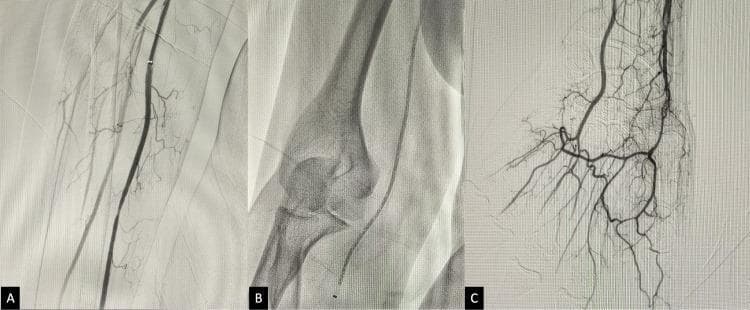 This composite diagnostic image consists of three digital subtraction angiogram (DSA) frames (A, B, and C) illustrating the endovascular revascularization of a right upper limb following acute thrombotic occlusion.
Frame A shows the brachial artery post-thrombolysis with restored patency in the main vessel and visible collateral branching, though distal opacification remains incomplete. Frame B is an intra-procedural fluoroscopic image showing the elbow joint (distal humerus and proximal radius/ulna) with a distal access catheter (DAC) positioned for thromboaspiration. Frame C demonstrates the successful final result, showing complete recanalization and robust contrast filling of the distal arterial network, including the radial and ulnar arteries and the deep and superficial palmar arches in the hand.
The series illustrates key steps in managing acute limb ischemia: the transition from initial pharmacological thrombolysis to mechanical thromboaspiration, ending with definitive restoration of distal perfusion. The visualization of the intricate palmar arterial anatomy in Frame C serves as the clinical endpoint for successful recanalization.
