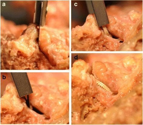 This set of clinical photographs (labeled a-d) illustrates the sequential steps of a major facet restoration procedure on a human cadaveric lumbar spine. The series demonstrates: a) Initial access to the zygapophyseal (facet) joint line using a surgical instrument; b) Mechanical distraction of the superior and inferior articular processes to widen the joint space; c) Insertion of a Glyder facet joint implant via a specialized delivery tool and cannula, showing the implant's characteristic ridged/toothed surface designed for stable fixation; and d) Final anatomical positioning of the implant within the joint space to maintain distraction and restore joint height. The facet capsule has been reflected for experimental visibility. This visual illustrates a minimally invasive surgical technique aimed at treating facetogenic back pain by restoring mechanical spacing and joint alignment in the posterior spinal column. Key anatomical landmarks include the articular cartilage surfaces and subchondral bone of the facet joint complex.