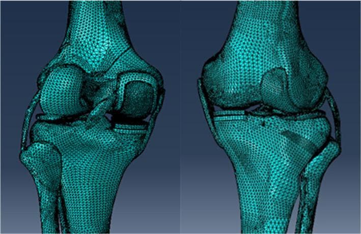 This image presents two views of a high-fidelity 3D computational model of a human knee joint featuring a Unicompartmental Knee Arthroplasty (UKA). The model is rendered using a complex triangular finite element mesh, providing a faceted visualization of the anatomical and prosthetic surfaces. The anatomy shown includes the distal femur, proximal tibia, and proximal fibula. Crucial soft tissue structures, including the anterior and posterior cruciate ligaments (ACL/PCL) and the medial and lateral collateral ligaments (MCL/LCL), are modeled as cable-like structures connecting the bony elements. The UKA is situated in the medial compartment, consisting of a metallic femoral condyle resurfacing component and a tibial baseplate platform. The model is designed for biomechanical stress analysis and surgical simulation, specifically investigating the impact of tibial component alignment and obliquity on load distribution. The teal-colored mesh highlights the geometry used for finite element analysis (FEA), demonstrating the interaction between the prosthetic implants and the native bone-cartilage complex.