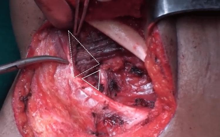 This clinical photograph displays an intraoperative view of a human neck dissection, specifically focusing on the submandibular region after the removal of the submandibular gland and level IB lymph nodes. The surgical field highlights key anatomical landmarks used for identifying deep vascular structures. Two superimposed geometric overlays delineate critical surgical triangles: the dashed white triangle indicates Lesser's triangle, and the solid white triangle indicates Pirogoff's triangle. Visible anatomical components include the mylohyoid muscle being retracted superiorly with a Langenbeck retractor, the hyoglossus muscle forming the floor of the triangles, and the hypoglossal nerve passing through the region. Surgical instruments, including forceps and retractors, are positioned to provide exposure. These landmarks are clinically significant for the safe identification and ligation of the lingual artery during radical or modified radical neck dissections. The image serves as an educational tool for head and neck surgery, demonstrating surgical anatomy and the boundaries of the submandibular workspace.