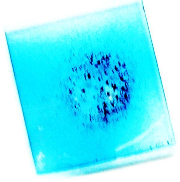 A clinical photograph showing a gross view of a glass slide used in a 'Superagglutination' test for serodiagnosis. The image captures the reaction with the unaided eye, demonstrating a positive result characterized by distinct macro-agglutination. A light blue background, created by the addition of Coomassie Blue dye to the test serum, surrounds a central cluster of dark, dense clumps. These clumps represent the cross-linked aggregates formed by the interaction between microbial antigens (originally stained with Rose Bengal dye) and serum antibodies, enhanced through biotin-streptavidin cross-linking. The non-uniform, granular distribution of these dark particles against the uniform blue liquid confirms the presence of specific antibodies. This diagnostic method is used to increase the sensitivity and visual clarity of standard agglutination assays, such as those for Brucella, by magnifying the clump size and providing color contrast for easier clinical interpretation.