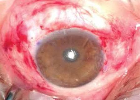 This clinical photograph displays a human eye immediately following double pterygium surgery (nasal and temporal) with conjunctival autografting. The central cornea appears relatively clear and smooth, indicating successful excision of the pterygium heads. Surrounding the limbus, the bulbar conjunctiva shows significant post-operative changes, including diffuse erythema, subconjunctival hemorrhage, and visible tissue manipulation consistent with the placement of autologous grafts. The grafts are positioned to cover the exposed scleral beds at the nasal and temporal aspects of the limbus. Fine sutures (8/0 vicryl) are implicitly present where the graft edges meet the recipient conjunctiva, contributing to the irregular surface texture in the perilimbal area. The image demonstrates the immediate surgical outcome of a conjunctival autograft procedure, a common technique used to reduce recurrence rates after pterygium removal.