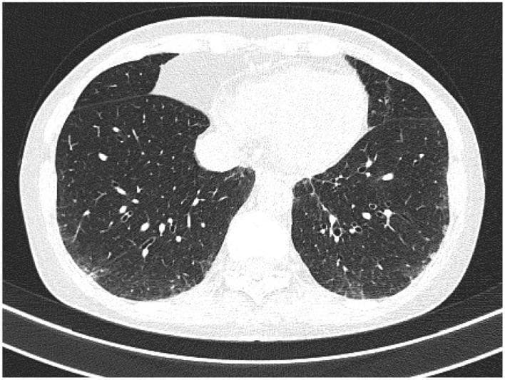 High-resolution computed tomography (HRCT) of the chest in axial view demonstrating bilateral bronchiectasis in a patient with rheumatoid arthritis. The imaging shows classic signs of airway pathology, specifically the 'signet-ring sign,' where dilated bronchi are seen adjacent to smaller pulmonary arteries, indicating a broncho-arterial ratio significantly greater than 1. The bronchial walls are visibly thickened and exhibit a lack of normal tapering as they extend toward the lung periphery. These dilated, thick-walled airways are distributed throughout the lung parenchyma, appearing as circular or oval lucencies. In addition to the bronchiectatic changes, there is evidence of mild interstitial thickening and subtle patchy opacities. This diagnostic image illustrates a common extra-articular manifestation of rheumatoid arthritis, highlighting chronic inflammatory damage to the lower airways resulting in permanent bronchial dilation and structural remodeling.