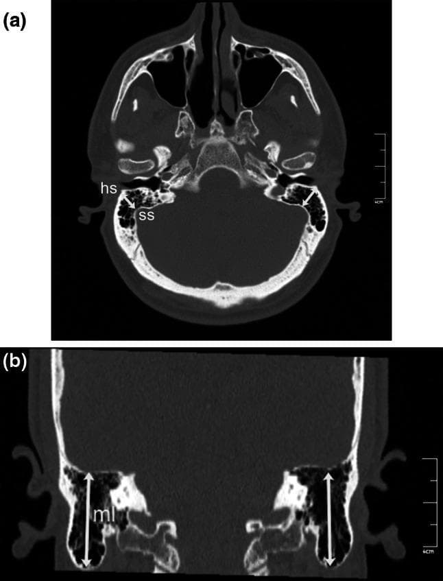 This educational resource features two reformatted computed tomography (CT) images of the human skull base and temporal bone region, highlighting key landmarks for mastoid morphometry. Image (a) is an oblique axial CT scan demonstrating 'mastoid depth.' It identifies the Henle suprameatal spine (hs) as a bony landmark on the lateral mastoid surface and illustrates the shortest distance (white arrow) to the sigmoid sinus (ss). This measurement is crucial for surgical planning in mastoidectomies to avoid vascular injury. Image (b) is a coronal reformatted CT scan showing 'mastoid length' (ml). A vertical double-headed white arrow measures the distance between the superior boundary, the tegmen tympani (the roof of the middle ear and mastoid antrum), and the inferior boundary, the mastoid tip. These diagnostic images serve as a teaching tool for radiological anatomy, specifically focusing on the spatial relationships between surgical landmarks and critical neurovascular structures within the mastoid process of the temporal bone.