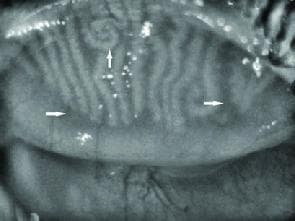 This diagnostic clinical image, likely obtained via meibography, displays the meibomian glands within a human eyelid. The glands are visible as vertically oriented, light-colored parallel structures. Pathological changes associated with meibomian gland dysfunction (MGD) are highlighted by white arrows. A vertical arrow in the upper-left quadrant points to a region of increased ductal tortuosity, where the gland exhibits a spiraling or twisting morphology rather than a linear path. Horizontal arrows on the left and right peripheries indicate areas of focal gland atrophy or dropout, where the normal vertical stripes are significantly diminished or absent against the tarsal background. The image serves as an educational tool for ophthalmology and optometry to demonstrate the structural degradation and morphological remodeling of oil-producing glands in chronic ocular surface disease.