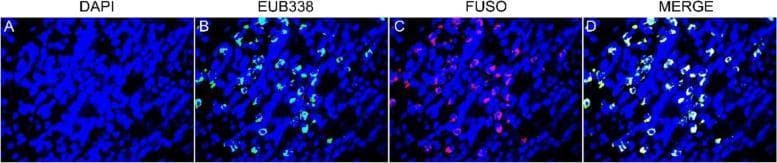 This diagnostic image series displays fluorescence in situ hybridization (FISH) micrographs of esophageal squamous cell carcinoma (ESCC) tissue specimens at 400x magnification. The panel illustrates the detection and localization of Fusobacterium nucleatum within the tumor microenvironment using specific molecular probes. Panel A shows DAPI staining, which identifies host cell nuclei in blue. Panel B adds the EUB338 universal bacterial probe, highlighting all conserved bacterial regions in green. Panel C utilizes the FUSO probe to specifically identify Fusobacterium-specific regions in red. Panel D presents a triple-stained merged image (DAPI/EUB338/FUSO), demonstrating the spatial co-localization of F. nucleatum within the broader bacterial population and its proximity to the ESCC tumor cells. This visual evidence supports the clinical finding of Fusobacterium nucleatum enrichment in esophageal malignant tissues, serving as a key educational tool for understanding microbial involvement in gastrointestinal carcinogenesis and the application of multi-color FISH in diagnostic pathology.