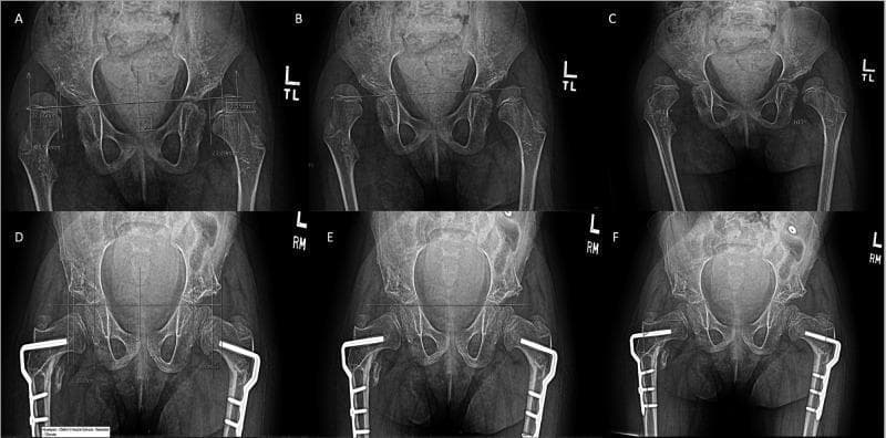 A series of six anteroposterior (AP) pelvic radiographs demonstrating a comparison of pre-operative and post-operative status following a Varus Derotation Osteotomy (VDRO) for neuromuscular hip dysplasia. Images A, B, and C show the pre-operative baseline where bilateral coxa valga and subluxation of the femoral heads are present; quantitative measurements include the migration percentage (MP) in A, the acetabular index (AI) in B, and the anatomical medial proximal femoral angle (aMPFA) in C. Images D, E, and F show the post-operative outcomes using the same measurement techniques. Visible surgical changes include bilateral proximal femoral plates and screws used for internal fixation. Post-operative views demonstrate improved coverage of the femoral heads within the acetabula, correction of the femoral neck-shaft angle to a more varus orientation, and stabilization of the hip joint. The content illustrates the radiographic assessment of hip dysplasia progression and surgical correction in the context of cerebral palsy management.