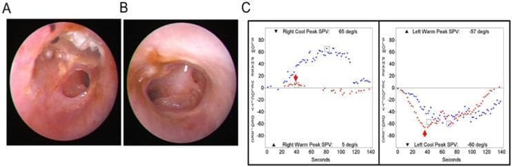 This composite image illustrates diagnostic findings for a 77-year-old patient with bilateral chronic otitis media. Panels A and B are otoendoscopic clinical photographs showing bilateral tympanic membrane pathology. Panel A displays the right ear with a visible epitympanic cholesteatoma and central perforation, while Panel B displays the left ear with a large central tympanic membrane perforation. Panel C contains two graphs from a bithermal caloric test, plotting Slow Phase Velocity (SPV) in degrees per second against time in seconds. The graphs demonstrate 'caloric inversion' during warm air irrigation. Red arrows indicate the peak SPV points where the nystagmus response is opposite in direction to the expected physiological response (inverted). This visual documentation is highly relevant for otolaryngology education, specifically in diagnosing vestibular dysfunction in the presence of middle ear disease and perforated tympanic membranes.