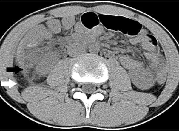 This transverse (axial) CT scan of a pediatric patient demonstrates a primary diagnosis of complicated appendicitis, characterized by an enlarged appendix and secondary inflammatory changes in the retroperitoneal space (RPS). The image highlights fluid collections and thickening across several interfascial planes. Specifically, fluid accumulation is visible in the lateral conal plane (indicated by a black arrow) and the subfascial plane (indicated by a white arrow). Additionally, pathology is noted in the retrorenal plane and surrounding the bridging septa. These findings manifest as regions of increased density and fluid tracks that disrupt the normal fat attenuation of the retroperitoneum. The scan serves as a clinical example of how inflammatory processes from the appendix can track into specific fascial compartments, which is a key radiological indicator for distinguishing between complicated and uncomplicated appendicitis in a clinical setting.