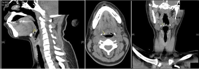 A three-panel diagnostic Computed Tomography (CT) scan of the neck and upper aerodigestive tract, presented in sagittal (left), axial (center), and coronal (right) planes. The images demonstrate a radiopaque, curvilinear foreign body, consistent with a fish bone, measuring approximately 2 cm in length. Yellow arrows indicate the object's precise location within the right vallecula, the anatomical space between the base of the tongue and the epiglottis. The sagittal view reveals the object's curved morphology anterior to the epiglottis; the axial view shows its position lateral to the midline near the tongue base; and the coronal view confirms its right-sided orientation within the pharyngeal space. Visible anatomical landmarks include the mandible, hyoid bone, cervical vertebrae, and airway. This imaging panel is used in otolaryngology and emergency medicine to teach the radiographic identification of ingested foreign bodies and their potential for airway obstruction or local tissue injury.
