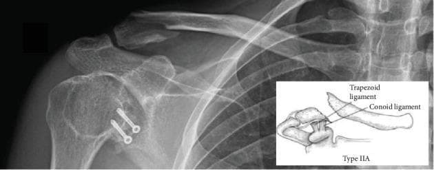 Anteroposterior (AP) radiograph of the right shoulder and clavicle demonstrating a distal clavicle fracture, classified as Neer type IIA. The fracture is located medial to the coracoclavicular (CC) ligaments, resulting in a characteristic superior displacement of the proximal clavicle fragment due to the pull of the sternocleidomastoid muscle, while the distal fragment remains attached to the acromion. Adjacent to the glenohumeral joint, two metallic cortical screws with washers are visible, originating from a previous Latarjet procedure; these are positioned within the coracoid process remnant and appear stable. An inset anatomical diagram illustrates the Neer type IIA classification, specifically highlighting the relationship between the fracture line and the conoid and trapezoid components of the CC ligament. The image serves as an educational tool for identifying unstable distal clavicle fractures and assessing postoperative orthopedic hardware in the context of complex shoulder trauma history.