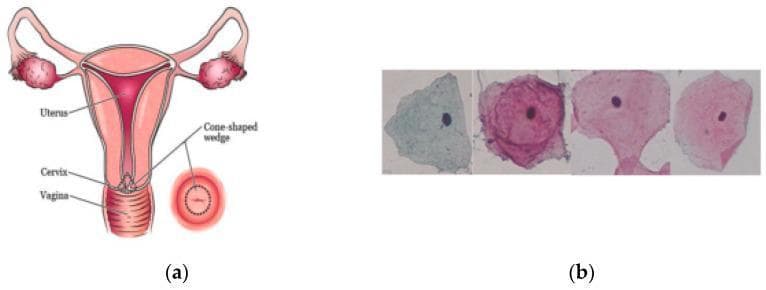 This composite educational figure illustrates the anatomical and cytological basis of cervical screening. Panel (a) is an anatomical diagram of the female reproductive system, displaying the uterus superiorly, the cervix at the mid-level, and the vagina inferiorly. It highlights a 'cone-shaped wedge' representing a cervical biopsy or diagnostic excision area, with a corresponding inset showing the cervical os in a transverse view. Panel (b) presents diagnostic cytology images from the Herlev dataset, showing individual cervical cells under microscopy. The cells demonstrate varying Papanicolaou-style staining patterns ranging from cyan/pale blue to magenta. Key visible features include centrally located, dark-stained nuclei surrounded by expansive, irregularly shaped cytoplasm with distinct polygonal or folded borders. This visual is designed for pathology and gynecology education, emphasizing the transition from macroscopic cervical anatomy to microscopic cellular morphology used in cancer screening and classification.