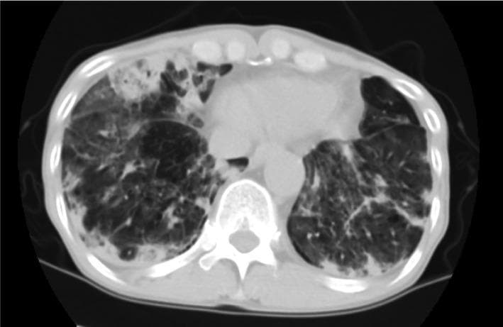 This diagnostic image is an axial chest computed tomography (CT) scan in a lung window, demonstrating severe bilateral pulmonary pathology. The scan shows extensive, multifocal areas of consolidation and patchy ground-glass opacities (GGO) distributed primarily in the lower lobes. In the right lung, particularly within the lower lobe, there are distinct cavitary lesions characterized by thick-walled, low-attenuation air-filled spaces, some of which exhibit internal air-fluid levels suggesting necrotizing pneumonia or abscess formation. The left lung also displays significant parenchymal involvement with dense opacification that obscures underlying vascular structures. The radiographic patterns are consistent with a severe inflammatory or infectious process, such as necrotizing community-acquired pneumonia or secondary bacterial infection (e.g., Pseudomonas aeruginosa). This visual material serves as an educational example of rapidly progressive pulmonary cavitation and the complex interplay between consolidation and ground-glass patterns in critical respiratory illness.