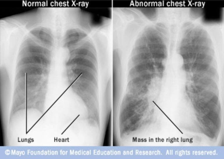 This Comparison Chart features two side-by-side posterior-anterior (PA) chest radiographs labeled 'Normal chest X-ray' and 'Abnormal chest X-ray'. The 'Normal' image depicts clear, radiolucent lung fields, sharp costophrenic angles, and a distinct cardiac silhouette. In contrast, the 'Abnormal' image demonstrates a significant focal opacity in the lower-to-middle zone of the right lung, labeled as a 'Mass in the right lung'. This finding represents a radiopaque lesion that obscures the normal pulmonary vascular markings and silhouettes the right heart border. The comparison serves as a diagnostic example for identifying primary lung neoplasms or large pulmonary masses. Key educational concepts include recognizing abnormal densities, understanding radiographic silhouettes, and differentiating healthy pulmonary parenchyma from pathological mass lesions. This material is suitable for undergraduate and intermediate medical education within the fields of radiology, pulmonology, and oncology.