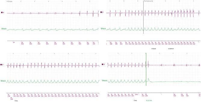 Diagnostic electrocardiographic (ECG) tracings from an implantable cardioverter-defibrillator (ICD) divided into four sequential panels illustrating the management of ventricular arrhythmias. The top row of each panel shows the ventricular intracardiac electrogram (EGM) in red (labeled 'V'), while the bottom row shows the 'Shock' channel in green. The sequence begins (top-left) with a baseline rhythm that transitions into a monomorphic ventricular tachycardia (VT), characterized by a sudden increase in frequency and regular, high-amplitude sharp peaks. The second and third panels (top-right, bottom-left) demonstrate the persistence of this high-frequency ventricular rhythm with associated markers indicating detection. In the final panel (bottom-right), a vertical green marker denotes the delivery of a high-energy defibrillation shock. Following the shock, there is an immediate termination of the tachycardia, evidenced by an abrupt change in the red waveform back to a lower frequency, lower amplitude, and more regular morphology, indicating successful restoration of a stable rhythm. Annotations at the bottom of the strips provide cycle length intervals in milliseconds, confirming the rate changes from VT to a non-tachycardic state.