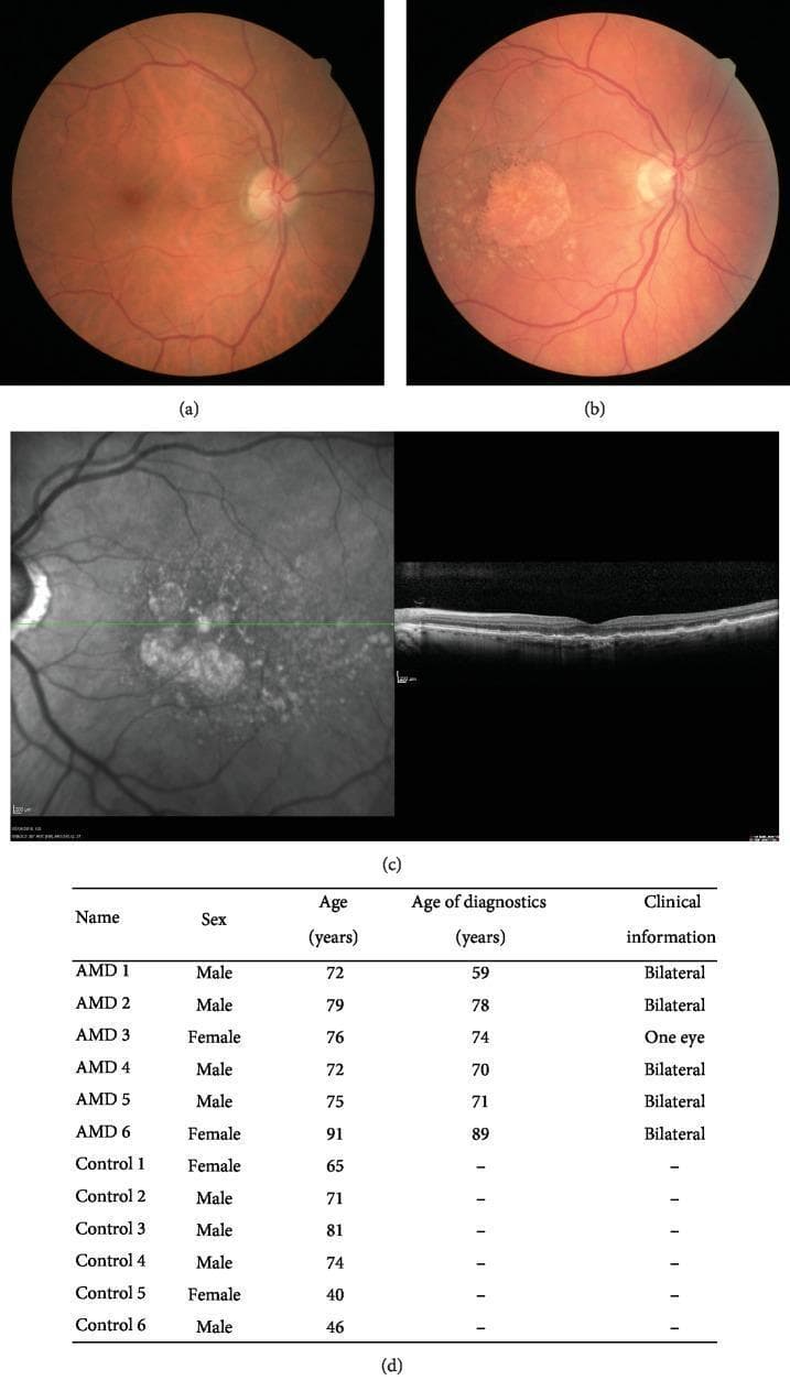 This composite clinical figure illustrates diagnostic findings for age-related macular degeneration (AMD). (a) Color fundus photograph of a healthy eye showing a normal optic disc, clear macular region, and standard vascular distribution. (b) Color fundus photograph of a patient with atrophic AMD, demonstrating geographic atrophy in the macula, characterized by a well-demarcated area of depigmentation, alongside multiple yellowish drusen deposits. (c) Optical Coherence Tomography (OCT) imaging of an AMD patient. The left panel shows a grayscale fundus infrared reflectance image with visible drusen; the right panel presents a cross-sectional Spectral-Domain OCT (SD-OCT) scan. The scan reveals characteristic pathology including thinning of the retinal layers, disruption of the retinal pigment epithelium (RPE) and photoreceptor layers, and sub-RPE deposits (drusen). (d) Comparison chart detailing demographic and clinical data for six AMD patients and six control subjects, including age at diagnosis and disease laterality. The image serves as an educational resource for identifying clinical signs of non-exudative (dry) AMD across different imaging modalities.