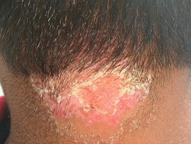 This clinical photograph displays a well-demarcated skin lesion characteristic of scalp psoriasis, located at the posterior hairline and extending onto the neck. The affected area is a prominent erythematous plaque with a vivid reddish-pink hue, indicating underlying inflammation. The lesion is characterized by thick, micaceous (silvery-white to yellowish) scales that are most densely concentrated along the irregular borders, partially adhering to the hair shafts and the scalp surface. The central portion of the plaque shows visible skin thickening and hyperkeratotic texture with less dense scaling. The surrounding skin appears relatively normal, though the plaque exhibits sharp demarcation from the healthy tissue. This image serves as a classic educational example of plaque psoriasis affecting the scalp and hairline, demonstrating key diagnostic features such as well-defined erythema and characteristic scaling patterns relevant for dermatology and primary care education.