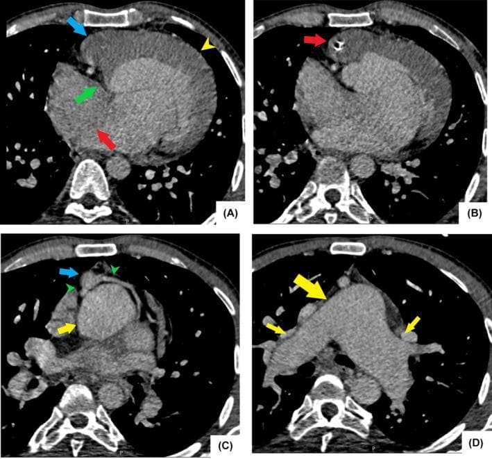 This diagnostic image consists of four axial cardiothoracic CT scan slices (A-D) demonstrating complex cyanotic congenital heart disease in an adult. Panel A (four-chamber view) shows tricuspid atresia, a hypoplastic right ventricle, a large atrial septal defect (ASD), and a significantly enlarged, hypertrophic left ventricle. Panel B identifies an atretic and calcified aortic valve originating from the hypoplastic right ventricle, consistent with levo-transposition of the great arteries (L-TGA). Panel C reveals a hypoplastic ascending aorta situated anteriorly to the main pulmonary artery, with evidence of normal coronary artery anatomy. Panel D illustrates significantly dilated central pulmonary arteries, a hallmark of secondary pulmonary hypertension. The series provides an educational overview of the structural remodeling and vascular changes associated with uncorrected tricuspid atresia Type IIc, including the specific spatial relationship of the great vessels and chambers. This content is suitable for advanced medical education in cardiology and radiology focusing on congenital heart defects and their late-stage clinical manifestations.