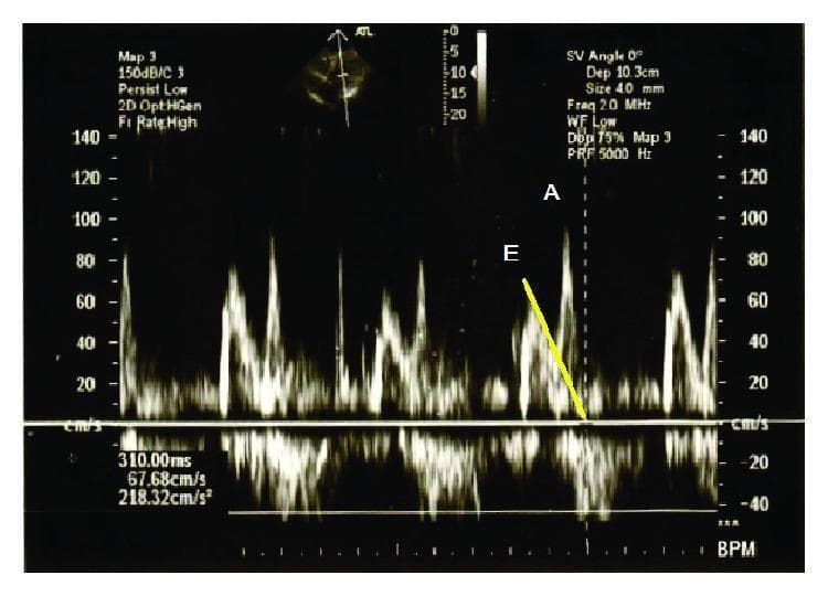 This diagnostic image shows a pulsed-wave Doppler spectral tracing used in echocardiography to evaluate left ventricular diastolic function. The spectral display plots blood flow velocity (y-axis, cm/s) against time (x-axis), demonstrating the characteristic transmitral flow profile. Two distinct positive peaks are labeled: the 'E' wave, representing early diastolic filling, and the 'A' wave, representing late diastolic filling during atrial contraction. In this tracing, the E/A ratio is less than 1 (E < A), which is indicative of impaired myocardial relaxation. A yellow superimposed line on the downslope of the E wave highlights the Deceleration Time (DT), measured here as 310 ms. The prolongation of the DT and the inverted E/A ratio are key diagnostic markers for Grade I diastolic dysfunction. Measurement readouts also include a peak velocity of 67.68 cm/s and an acceleration rate of 218.32 cm/s^2. A small 2D reference ultrasound image is visible at the top, showing the sampling volume placement.