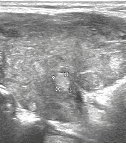 Diagnostic ultrasound image of the thyroid gland in a transverse or longitudinal view, demonstrating a solid, hyperechoic nodule. The nodule is demarcated by four calipers (X and + markers) indicating its dimensions. It exhibits increased echogenicity compared to the surrounding thyroid parenchyma, which itself displays a heterogeneous echotexture. The nodule possesses smooth, well-defined margins and a 'wider-than-tall' orientation. Notably, there is an absence of internal punctate echogenic foci, macrocalcifications, or posterior acoustic shadowing. These visual features are used in clinical practice to determine the ACR TI-RADS score; in this case, the combination of a solid composition (2 points) and hyperechogenicity (1 point) results in a total score of 3, classifying it as a TR3 (mildly suspicious) risk level. The image serves as an educational example of benign-appearing ultrasound morphology in thyroid pathology.