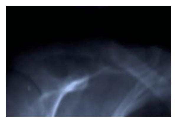 This anteroposterior (AP) radiograph of the right shoulder region demonstrates significant skeletal pathology of the clavicle. The image reveals a focal, expansile cystic lesion characterized by a well-defined area of radiolucency (decreased bone density) within the shaft of the clavicle. This lesion, consistent with osteitis fibrosa cystica (brown tumor), has caused marked thinning of the overlying cortical bone. A clear discontinuity in the cortical margin is visible through the lesion, signifying a pathologic fracture. The surrounding bone shows generalized osteopenia. This finding is a classic skeletal manifestation of primary hyperparathyroidism, where excessive parathyroid hormone leads to increased osteoclastic activity and the replacement of bone marrow with fibrous tissue and cystic vascular spaces.