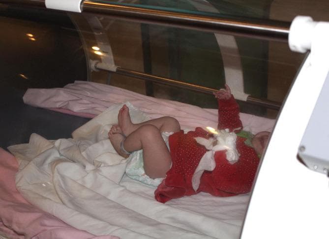 This clinical photograph displays an infant undergoing hyperbaric oxygen therapy (HBOT). The patient is positioned inside a specialized pediatric hyperbaric oxygen chamber, which is characterized by a transparent, cylindrical acrylic hull that allows for continuous visual monitoring by medical staff. The chamber is supported by a white structural frame with longitudinal metal reinforcement bars visible. The infant is supine on pink and white bedding, wearing a red patterned onesie and diaper. Visible medical monitoring includes a pulse oximetry sensor attached to the finger to track oxygen saturation during treatment. An identification or monitoring band is also present on the infant's ankle. This device is used in pediatric care to deliver high-pressure oxygen, often utilized in clinical scenarios such as tissue ischemia, complex wound healing, or carbon monoxide poisoning. The setup demonstrates the integration of neonatal intensive care monitoring within a pressurized therapeutic environment.