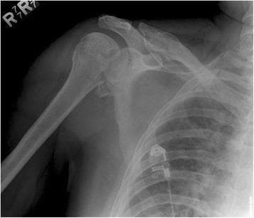 Anteroposterior (AP) radiograph of the right shoulder demonstrating a posterior glenohumeral dislocation. The humeral head is laterally displaced and lacks its normal overlap with the glenoid fossa, manifesting the 'light bulb sign' due to fixed internal rotation. A prominent cortical impaction fracture is visible on the anteromedial aspect of the humeral head, representing a reverse Hill-Sachs lesion (McLaughlin lesion), which typically occurs when the humeral head impacts against the posterior glenoid rim. There is a widened glenohumeral joint space, often referred to as the 'rim sign.' The anatomical landmarks of the clavicle, acromion, and proximal humeral shaft are otherwise intact. This diagnostic image is representative of orthopedic trauma imaging for shoulder instability and is used to identify associated osseous injuries that may require surgical intervention, such as rotational osteotomy.