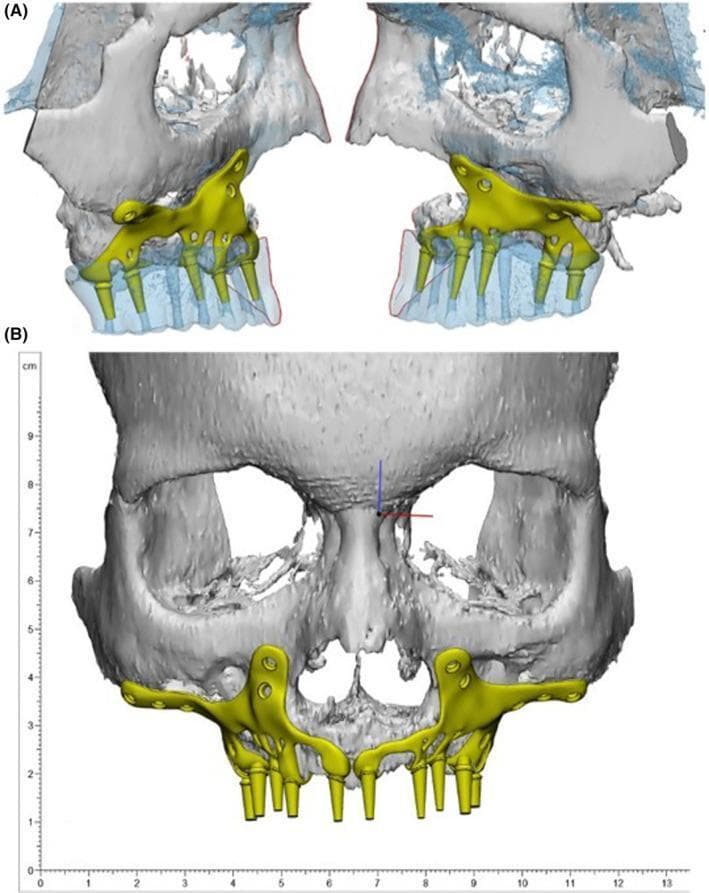 This composite image displays a 3D computer-aided design (CAD) of a customized subperiosteal implant (SPI) for maxillary reconstruction, used in cases of severe alveolar bone resorption. Panel (A) provides mirrored oblique views of the bilateral maxillary segments, showing the implant framework (highlighted in yellow) resting on the residual bone of the maxillary arch and zygomatic processes. The bone model is partially transparent, illustrating the orientation of the implant's internal support and the positioning of six downward-projecting cylindrical abutments intended for dental prostheses. Panel (B) presents a frontal (anterior-posterior) view of the midface and skull, demonstrating the complete bilateral SPI framework. The design features lateral wing-like extensions with integrated fixation screw holes for securing the titanium alloy structure to the stable bone of the zygomatic butts and paranasal areas. A centimeter ruler is visible on the left for scale. The visual serves to demonstrate patient-specific implant design and digital planning in maxillofacial prosthodontics and oral surgery.