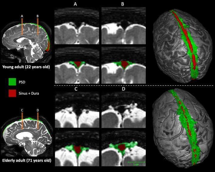 This diagnostic comparison image illustrates the age-related expansion of the parasagittal dural (PSD) space using T2-weighted MRI and 3D segmentation. The figure contrasts a young adult (22 years old) with an elderly adult (71 years old). High-resolution coronal slices focus on two neuroanatomical regions: the posterior aspect of the frontal lobe (A, C) and the anterior aspect of the parietal lobe (B, D). Color-coded label maps identify the PSD space in green and the superior sagittal sinus and contributing veins in red. In the elderly adult, there is a marked increase in the green-labeled PSD volume compared to the young adult, particularly evident in the anterior parietal region. The right-hand column presents 3D surface reconstructions of the brain, demonstrating a more extensive and wider distribution of the green PSD space along the longitudinal fissure in the older adult. These findings demonstrate the morphological changes of the parasagittal space associated with normal aging and its potential clinical significance in cerebrospinal fluid (CSF) dynamics and glymphatic function.