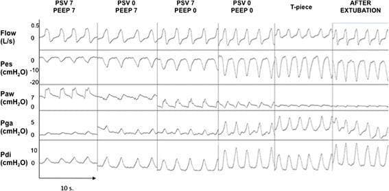 A comparative clinical physiological tracing showing the ventilatory patterns of a single patient across five different weaning tests (PSV 7/PEEP 7, PSV 0/PEEP 7, PSV 7/PEEP 0, PSV 0/PEEP 0, and T-piece) and 20 minutes post-extubation. The graphic displays six panels of continuous physiological data: Flow (L/s), Esophageal Pressure (Pes, cmH2O), Airway Pressure (Paw, cmH2O), Gastric Pressure (Pga, cmH2O), and Trans-diaphragmatic Pressure (Pdi, cmH2O). The tracings illustrate progressive changes in respiratory mechanics and effort. As pressure support ventilation (PSV) and positive end-expiratory pressure (PEEP) are reduced, there is a visible increase in the amplitude of negative Pes swings and positive Pdi swings, signifying increased inspiratory muscle effort and work of breathing (WOB). The PSV 0/PEEP 0 and T-piece trials most closely mirror the physiological effort observed in the 'After Extubation' state. This diagnostic diagram is used in intensive care medicine to evaluate spontaneous breathing trial (SBT) modalities and predict extubation success in mechanically ventilated patients.