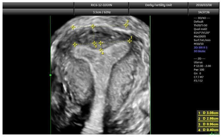 A 3D coronal plane ultrasound image of a human uterus, demonstrating the standard protocol for assessing congenital uterine anomalies (CUAs). The image features four key quantitative measurements used to differentiate between normal, arcuate, and septate morphologies. Line 1 (3.08 cm) represents the interostial line, connecting the interstitial portions of the fallopian tubes. Line 2 (2.98 cm) is a parallel reference along the serosal surface of the fundus. Measurement 3 (0.96 cm) indicates the uterine wall thickness, calculated as the vertical distance between the serosal surface and the interostial line. Measurement 4 (0.40 cm) quantifies the internal fundal indentation depth from the interostial line. The external fundal contour is smooth with no significant cleft, ruling out a bicornuate (U3) classification. The mild internal indentation of 0.40 cm is consistent with an arcuate uterus or a normal variant, as it does not meet the ESHRE/ESGE or ASRM criteria for a septate uterus. This diagnostic imaging is essential in reproductive medicine for evaluating Mullerian duct anomalies and fertility.