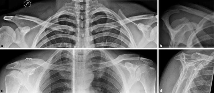 This set of diagnostic X-ray radiographs demonstrates the preoperative and postoperative evaluation of an acromioclavicular (AC) joint injury in a 26-year-old male. Radiograph A (panoramic view) shows a subtle superior displacement of the distal clavicle, initially suggesting a Rockwood type II injury. Radiograph B (Alexander view/scapular lateral) reveals significant horizontal instability with the distal clavicle overriding the acromion posterior-superiorly, confirming a Rockwood type IV injury. Radiograph C (postoperative panoramic view) displays the surgical correction using two dog-bone fixation devices bridging the coracoid process and the clavicle to stabilize the joint. Radiograph D (postoperative Alexander view at 6 weeks) confirms the resolution of horizontal instability with anatomic restoration of the acromioclavicular alignment. This series highlights the clinical significance of specialized radiographic views, such as the Alexander view, in identifying horizontal instability that may be masked in standard AP or panoramic projections, ultimately guiding orthopedic surgical intervention.
