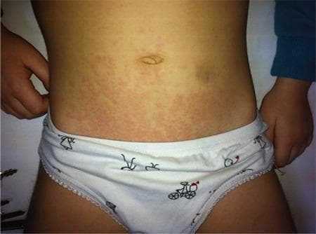 Clinical photograph of a pediatric patient's torso demonstrating the classic cutaneous manifestations of systemic juvenile idiopathic arthritis (sJIA). The image displays a salmon-pink colored, evanescent, maculopapular rash distributed across the abdomen and extending toward the proximal extremities. The individual lesions consist of small, circumscribed, pink macules and slightly elevated papules that appear non-pruritic and lack significant scaling. The arrangement is scattered and confluent in areas, creating a mottled or reticular pattern that fades gradually into the surrounding healthy skin. This specific dermatological finding is a hallmark diagnostic feature of sJIA, typically occurring during daily febrile spikes. The clinical relevance of this visual is to aid in the differential diagnosis of pediatric inflammatory conditions, distinguishing the characteristic sJIA rash from other childhood exanthems based on its specific color, distribution, and association with systemic symptoms.