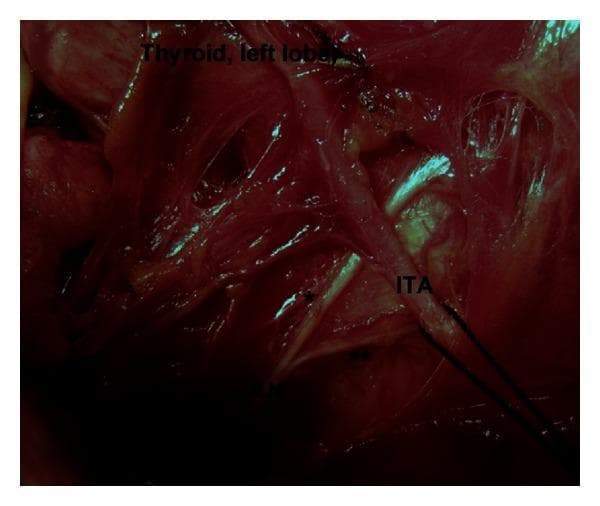 An intraoperative clinical photograph depicting the surgical anatomy of the left central neck compartment during thyroid surgery. The image highlights the anatomical relationship between the left inferior laryngeal nerve (ILN), also known as the recurrent laryngeal nerve, and the inferior thyroid artery (ITA). The photograph demonstrates a Type 4 variation, where the terminal division of the ILN into anterior (*) and posterior (**) branches occurs at the pre-arterial segment, proximal to its crossing with the ITA. The left lobe of the thyroid gland is visible in the upper portion of the surgical field. This visual is significant for endocrine surgery, illustrating extralaryngeal terminal bifurcation of the ILN, which is a critical landmark to identify to prevent iatrogenic nerve injury during thyroidectomy or parathyroidectomy. The image provides educational value regarding neurovascular variations and surgical risk regions in the cervical course of the laryngeal nerves.