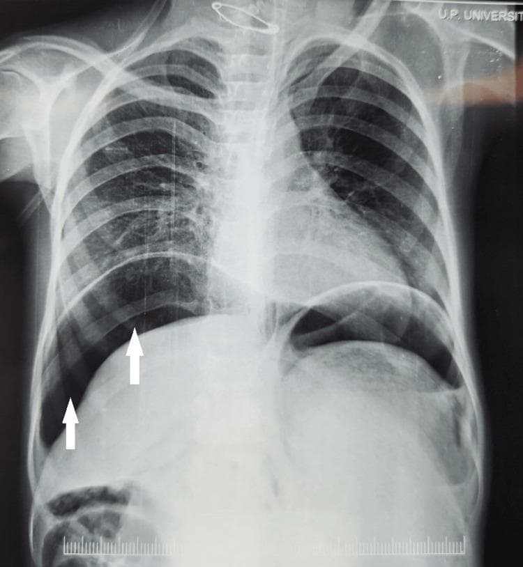 This diagnostic image is an erect posteroanterior (PA) chest X-ray demonstrating pneumoperitoneum. The most significant finding is the presence of subdiaphragmatic free air, visualized as crescent-shaped radiolucent (dark) areas immediately beneath both the right and left hemidiaphragms. White arrows specifically highlight the air-fluid interface on the right side, where gas has accumulated between the superior surface of the liver and the diaphragm. The upright positioning of the patient is confirmed by the upward migration of free intraperitoneal gas to the highest point of the abdominal cavity. This radiographic sign is a critical indicator of hollow viscus perforation, such as a perforated peptic ulcer or bowel rupture, which leads to peritonitis. The lung fields appear relatively clear, and the cardiac silhouette is visible, though the primary diagnostic focus is the abnormal gas collection in the upper abdomen. This image serves as a classic educational example of acute abdominal pathology visualized on a chest radiograph.