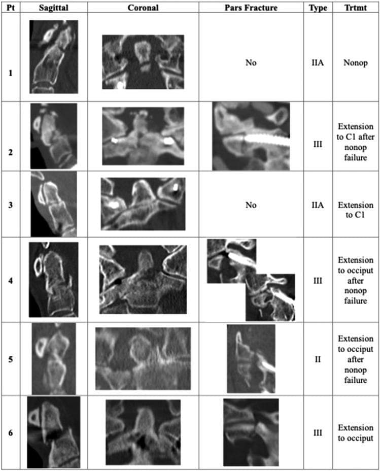 A composite clinical comparison chart showing CT scan images and classification data for proximal junctional dens fractures in six patients (Pt 1–6). The table is organized into five columns: sagittal imaging, coronal imaging, pars fracture status, fracture type, and treatment (Trtmt). The sagittal and coronal CT slices illustrate various C2 odontoid and body fracture morphologies, including some with pre-existing posterior spinal instrumentation. The 'Pars Fracture' column uses both text and focused CT images to indicate the presence or absence of a C2 pars fracture. The 'Type' column categorizes injuries according to a classification system (Type II, IIA, and III), while the 'Trtmt' column details clinical management, such as non-operative care (Nonop) or surgical extension to C1 or the occiput, often following non-operative failure. This visual resource serves as an educational tool for neuroradiology and orthopedic spine surgery, demonstrating the relationship between fracture morphology, classification, and management strategies in the context of adult spinal deformity.